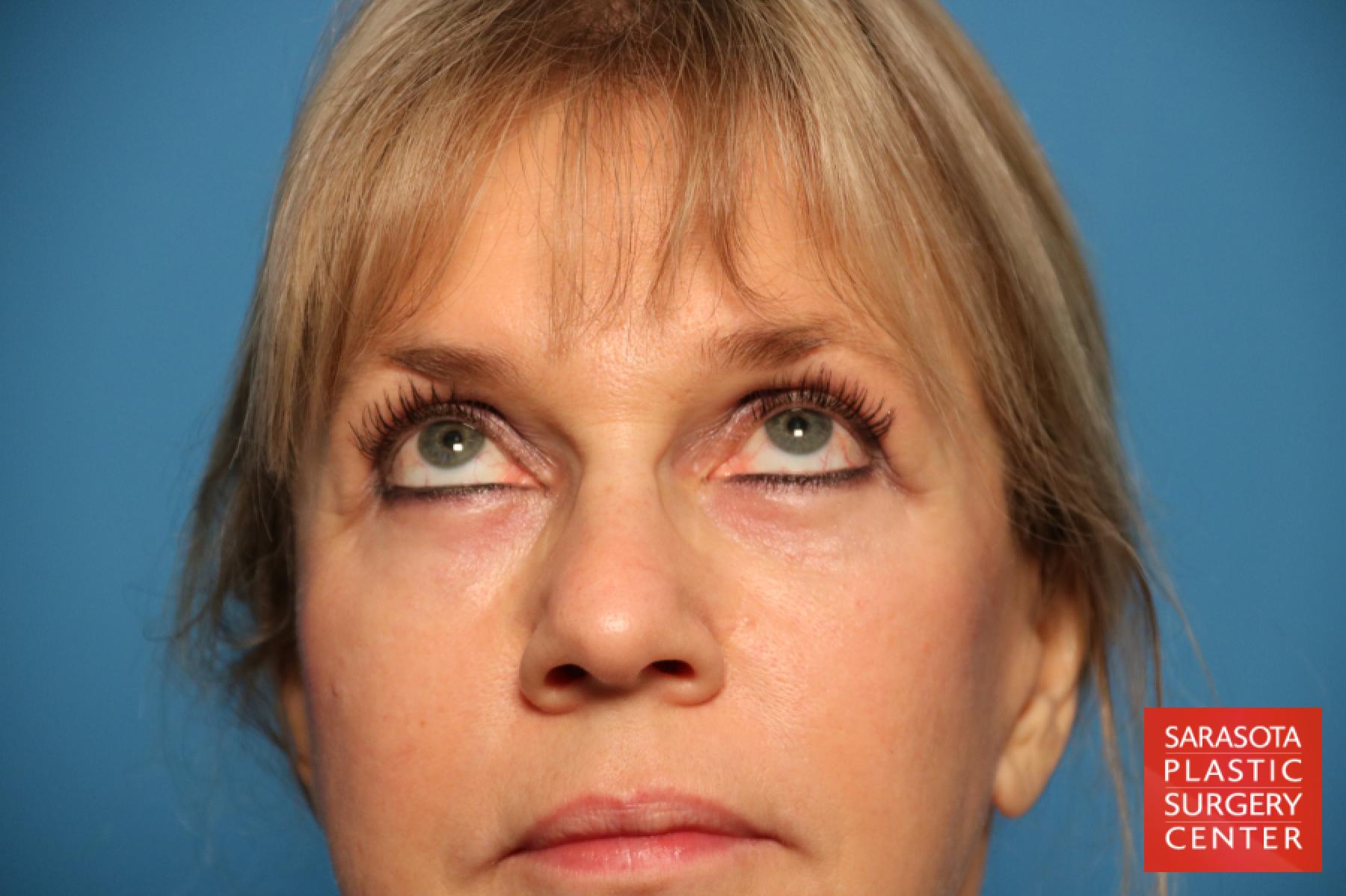 Eyelid Lift: Patient 7 - After 3