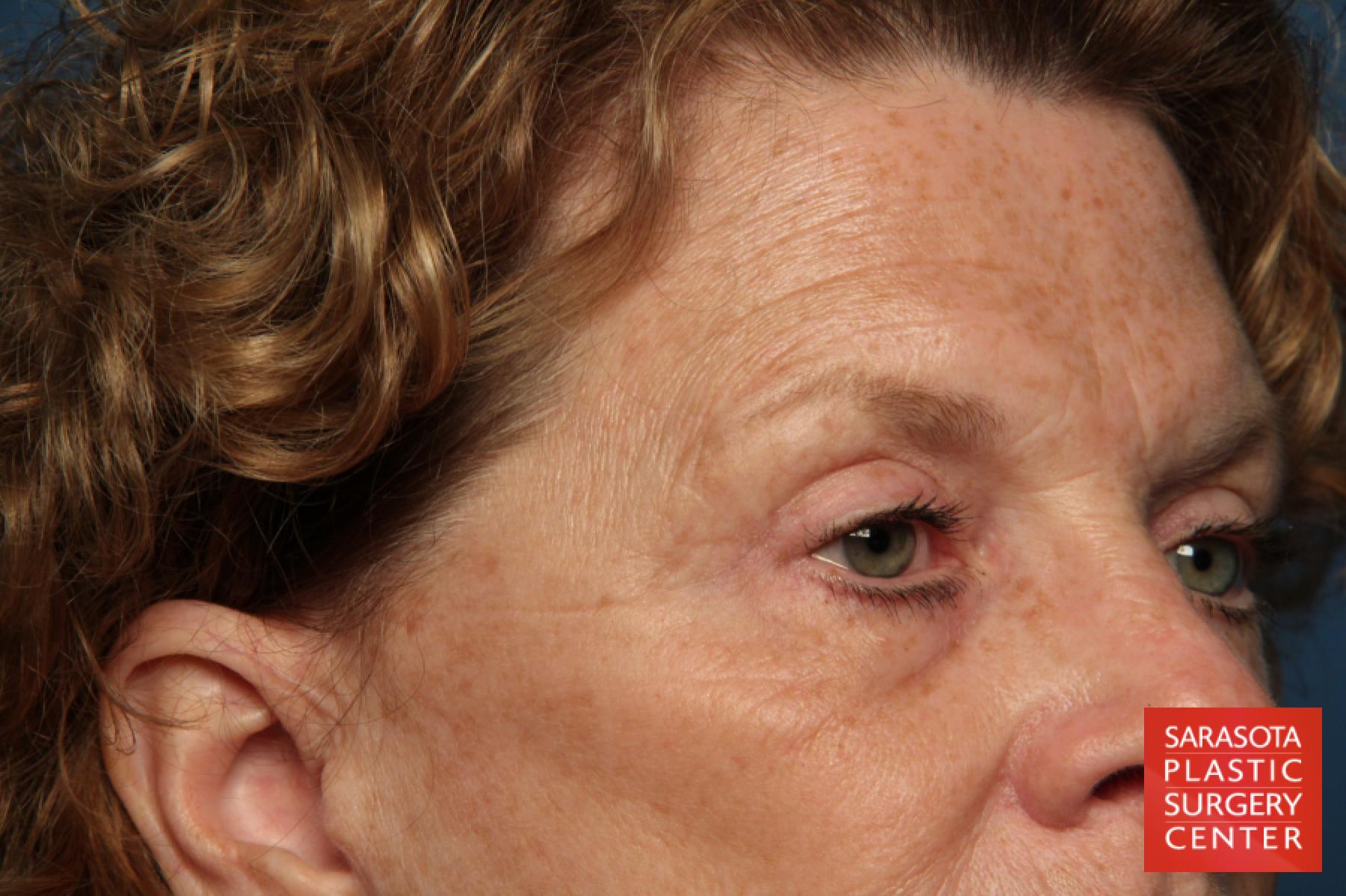 Eyelid Lift: Patient 25 - Before 2
