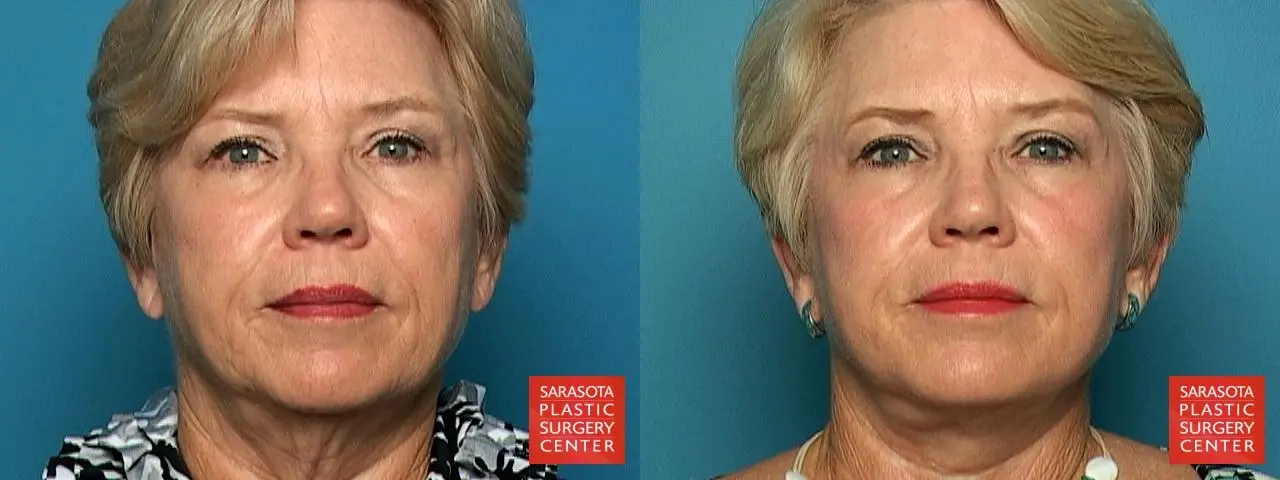 Neck Lift: Patient 1 - Before and After 1