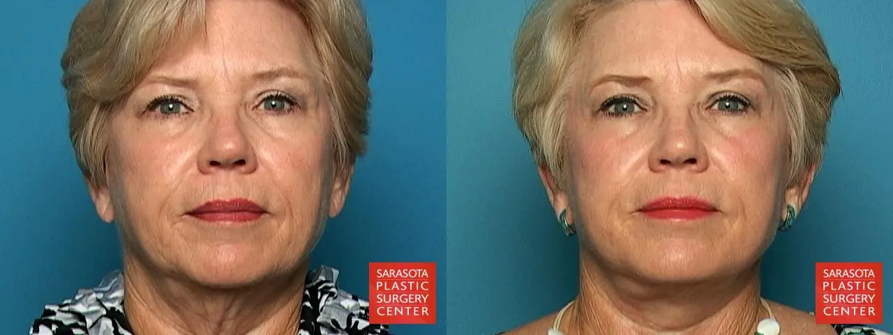 Neck Lift: Patient 9 - Before and After  