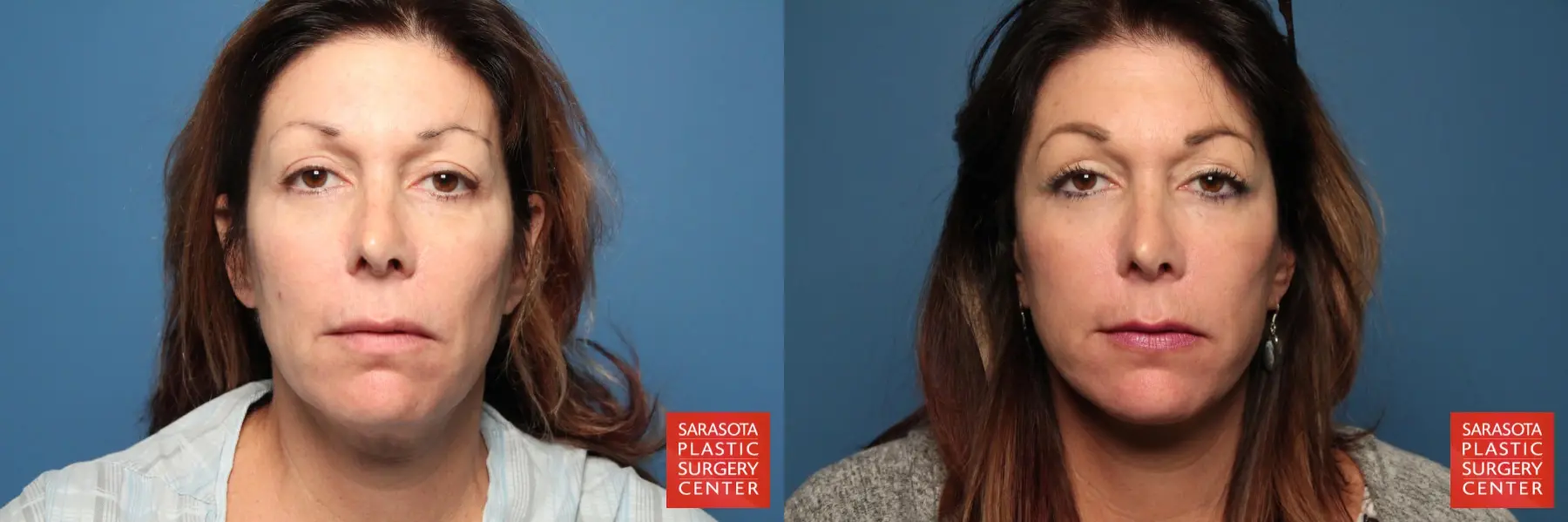 Neck Lift: Patient 11 - Before and After  