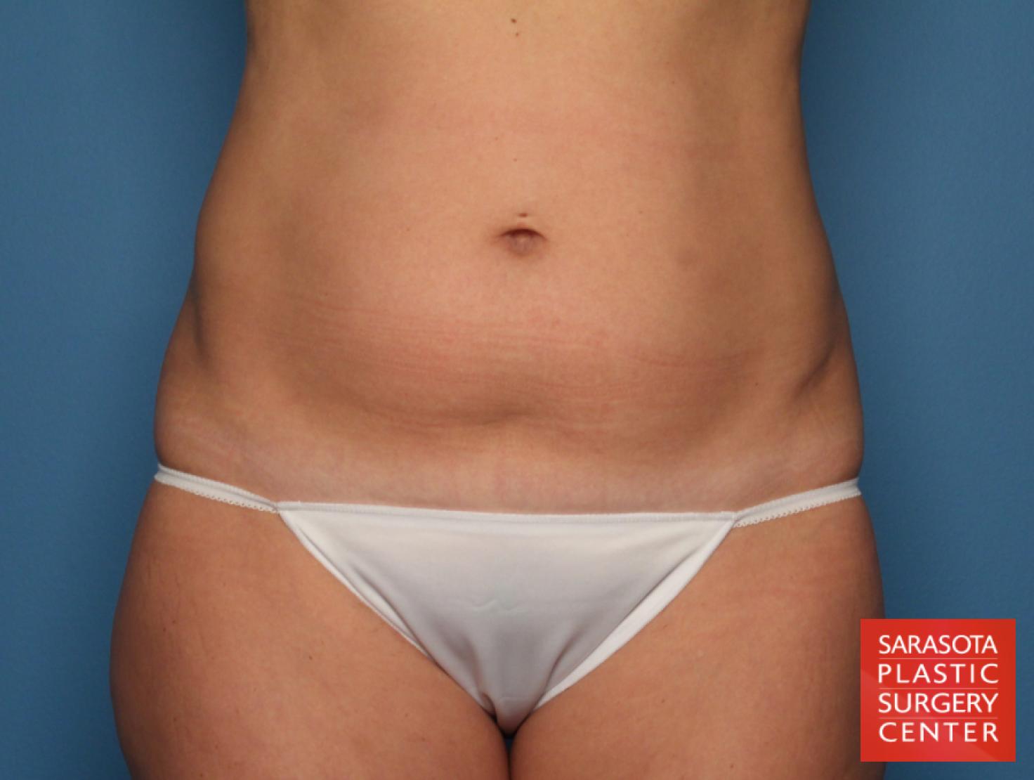 Tummy Tuck: Patient 20 - Before 1