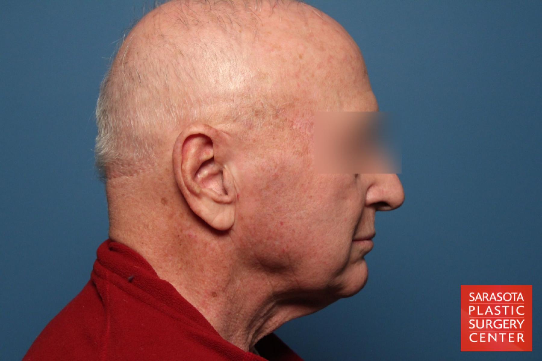 Neck Lift For Men: Patient 1 - Before and After 3