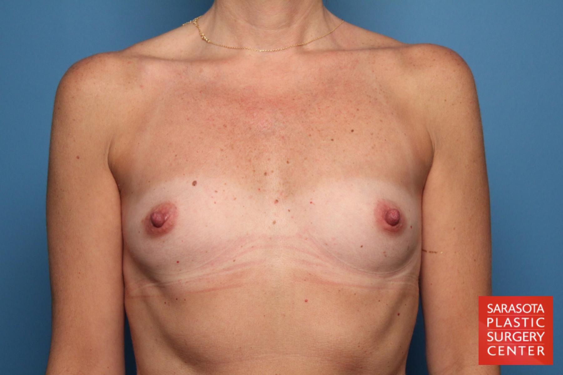 Breast Augmentation: Patient 19 - Before 1