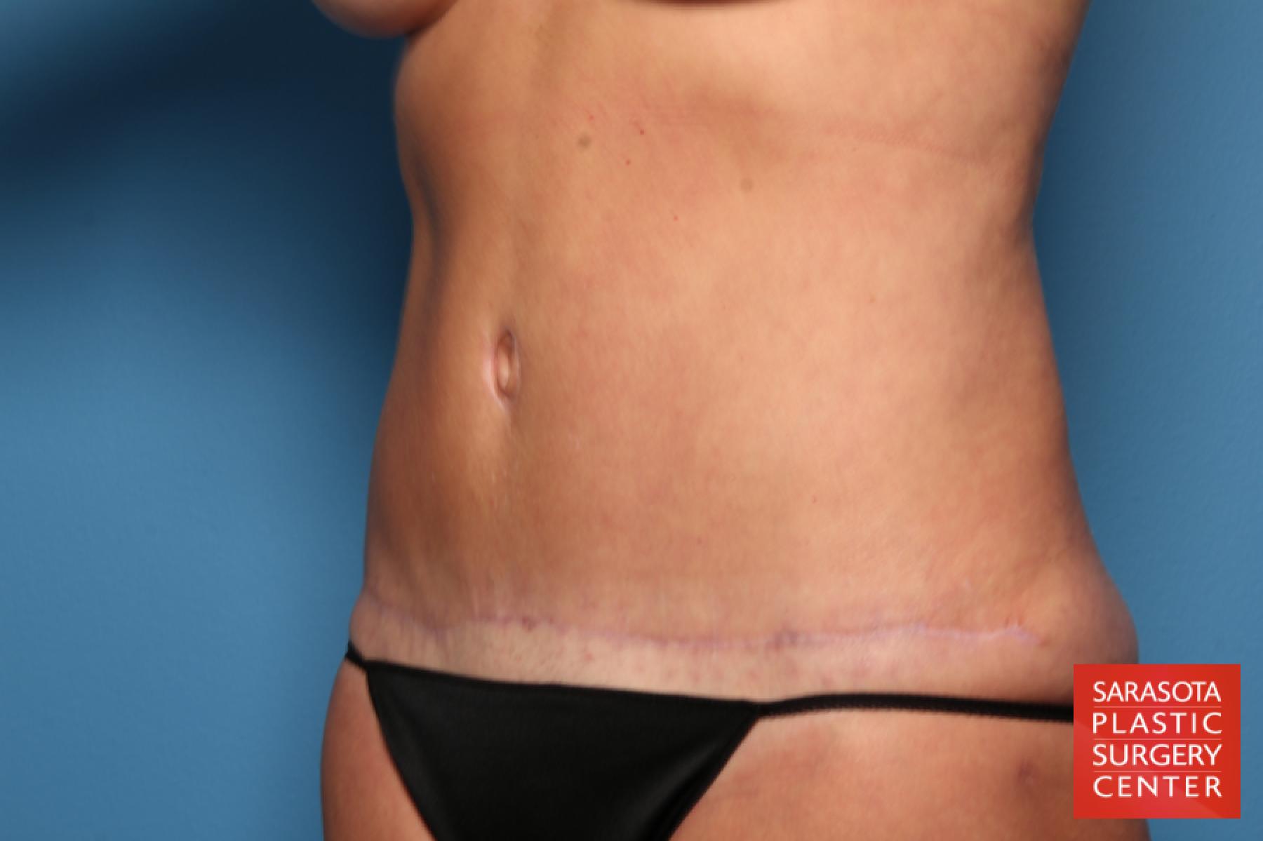 Tummy Tuck: Patient 25 - After 2