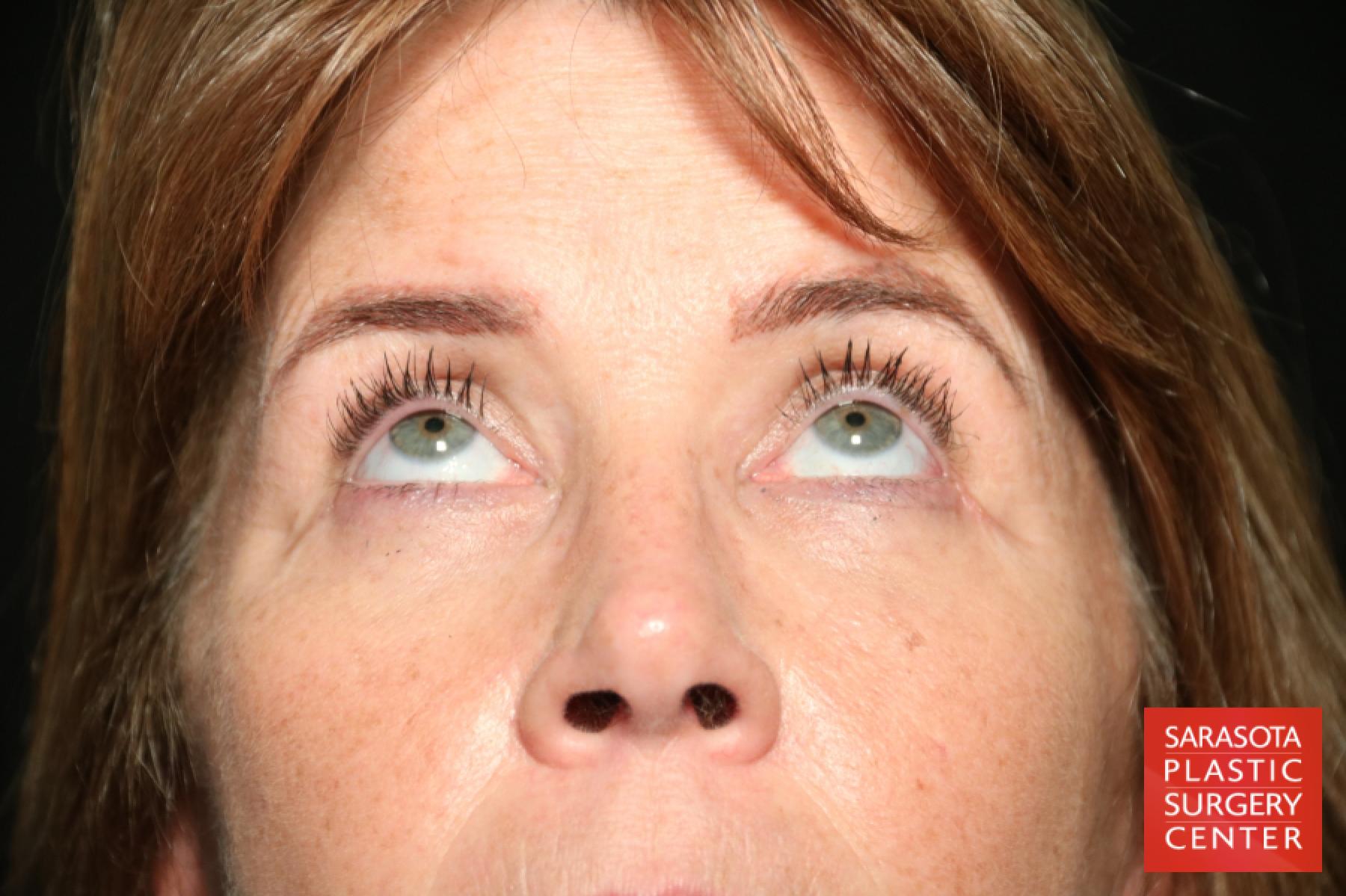 Eyelid Lift: Patient 37 - After 2