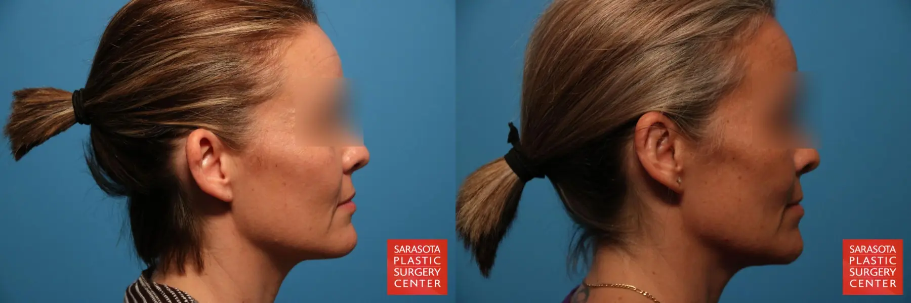 Otoplasty And Earlobe Repair: Patient 1 - Before and After 4