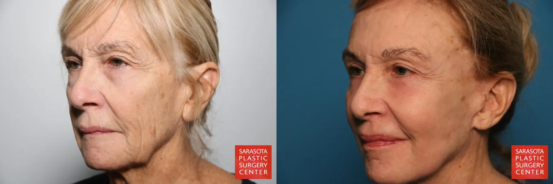 Otoplasty And Earlobe Repair: Patient 2 - Before and After 2