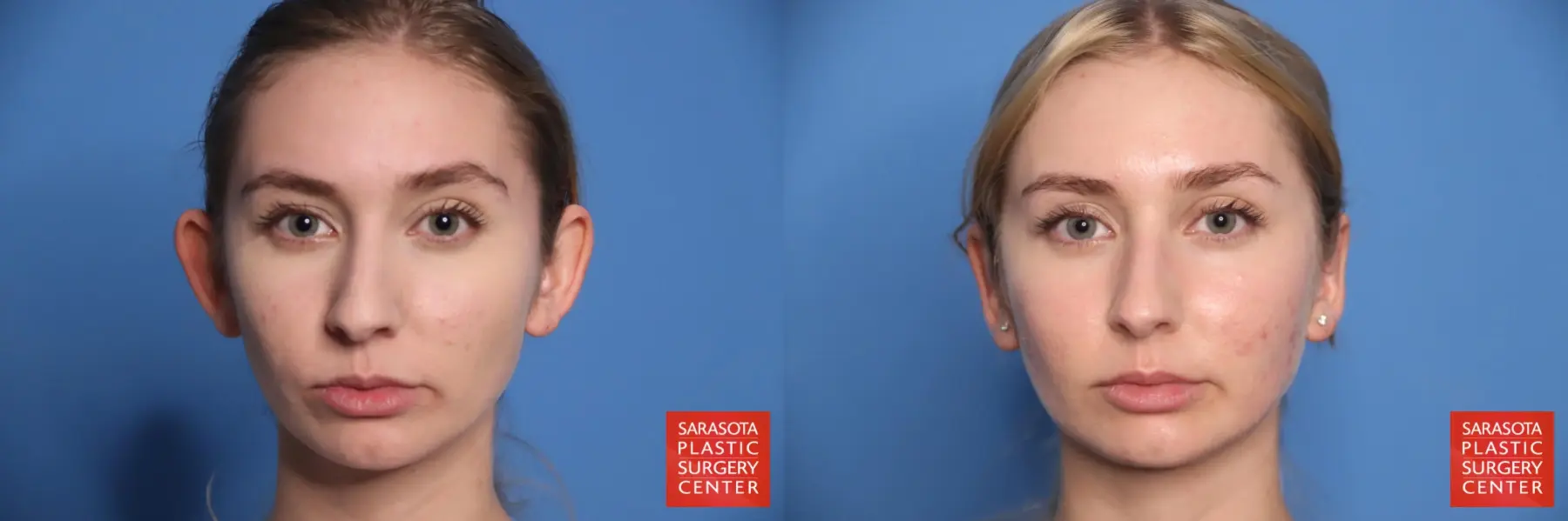 Otoplasty And Earlobe Repair: Patient 3 - Before and After  