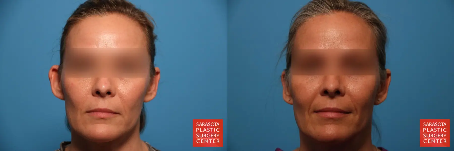 Otoplasty And Earlobe Repair: Patient 1 - Before and After  