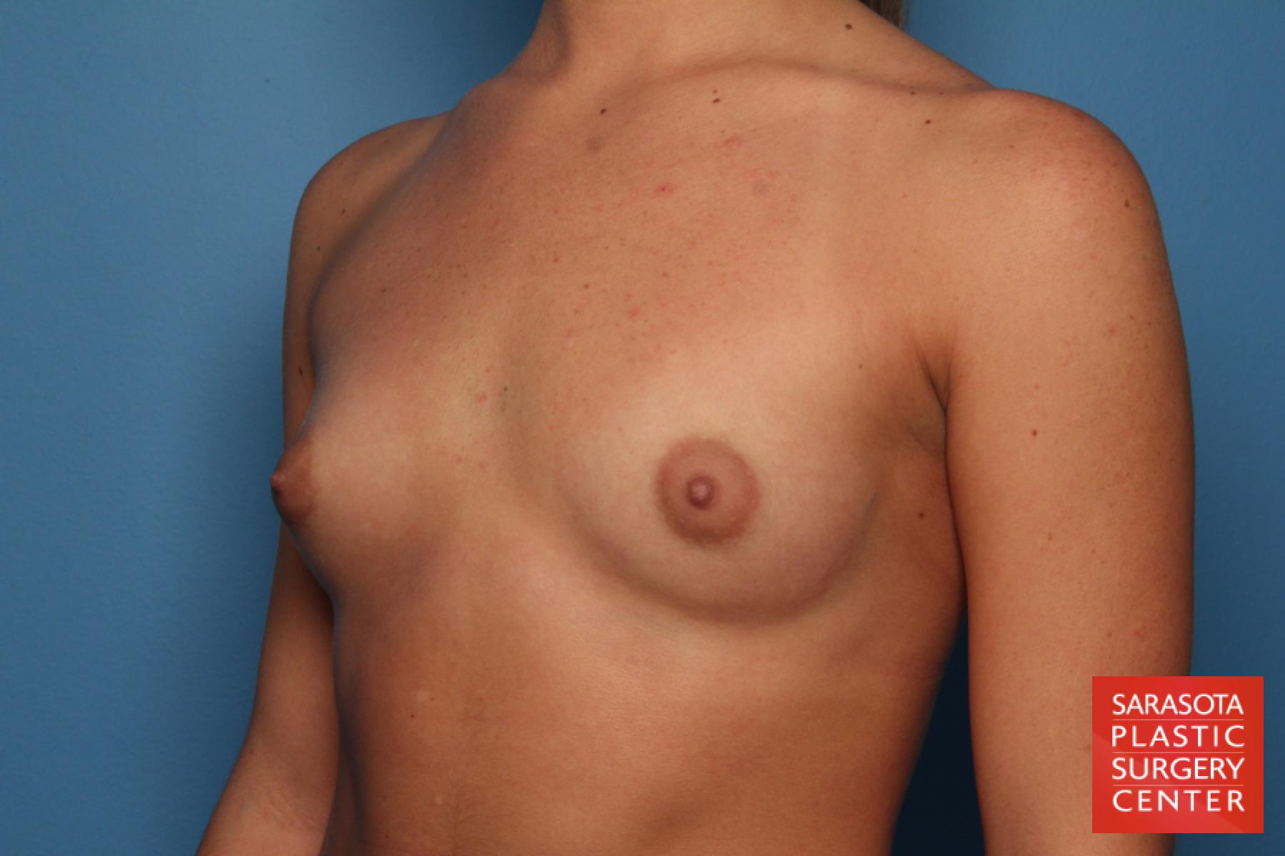 Breast Augmentation: Patient 65 - Before 2