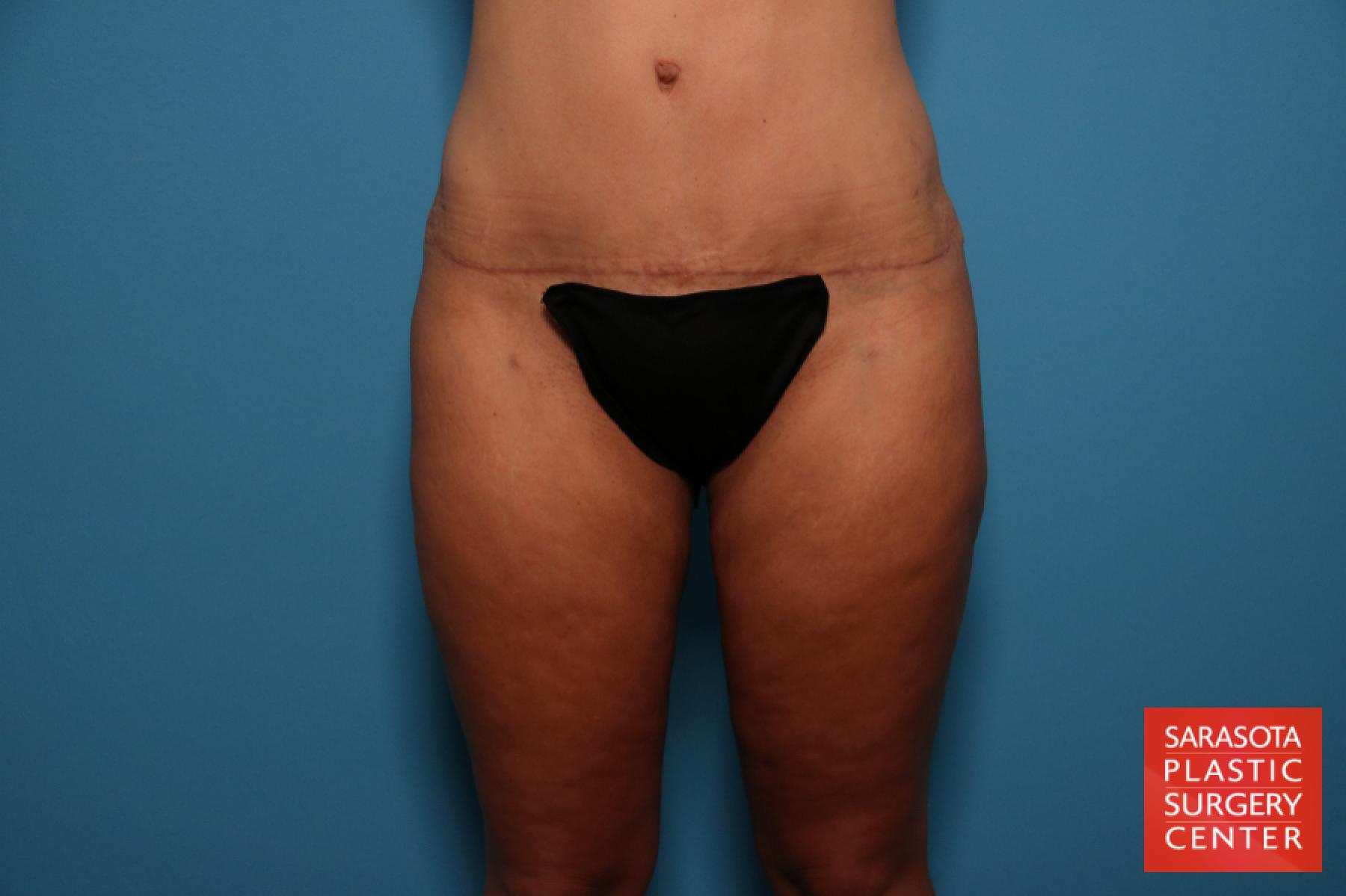 Liposuction: Patient 7 - After 2