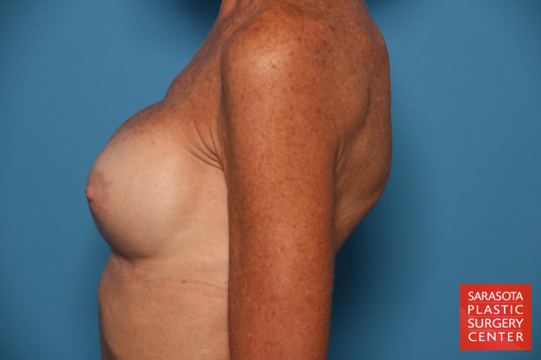Breast Revision: Patient 7 - After 3