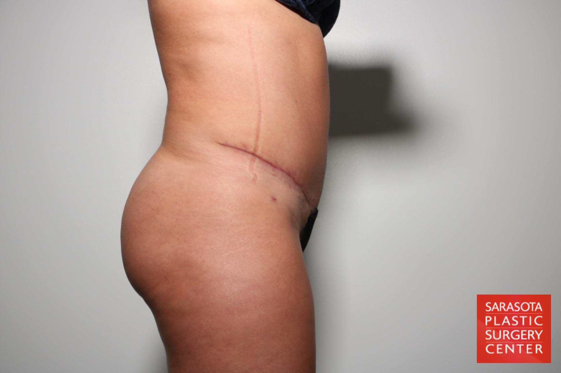 Tummy Tuck: Patient 24 - After 3