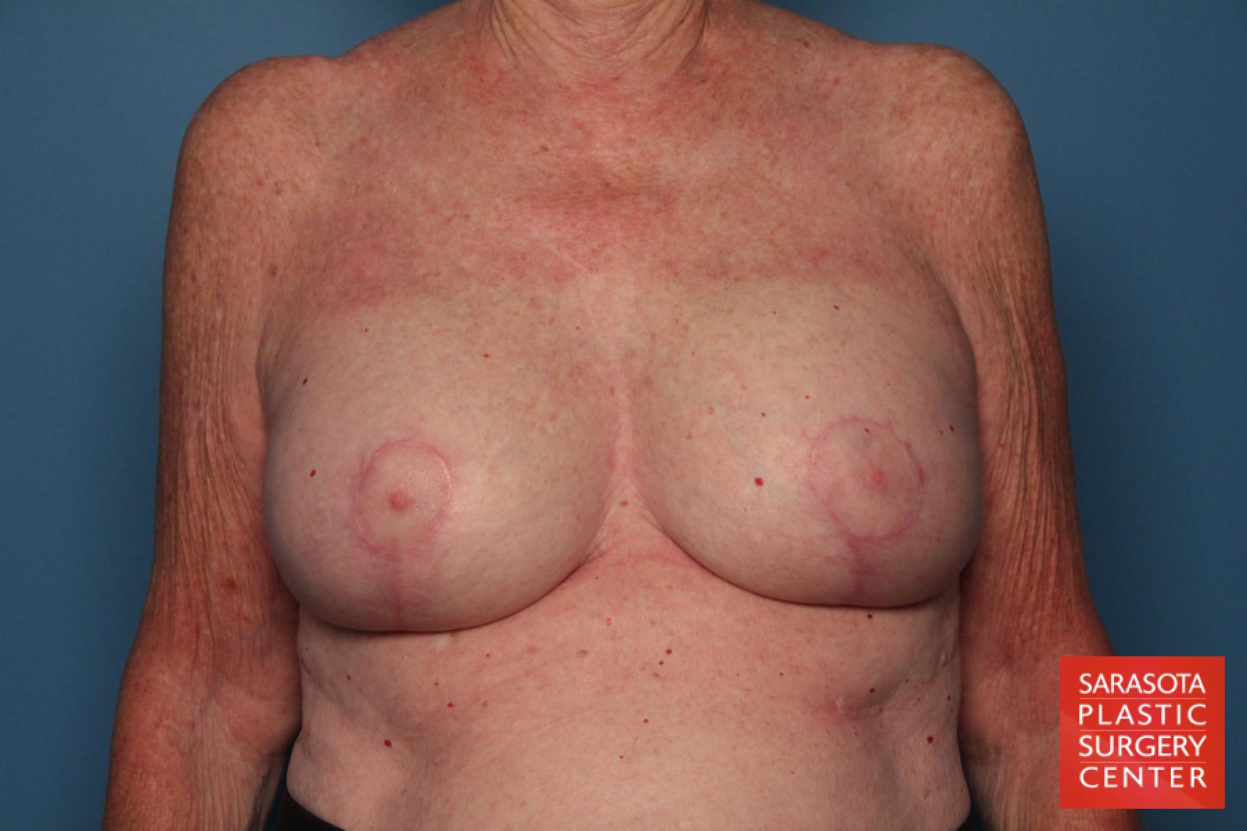Breast Implant Exchange: Patient 7 - After 1