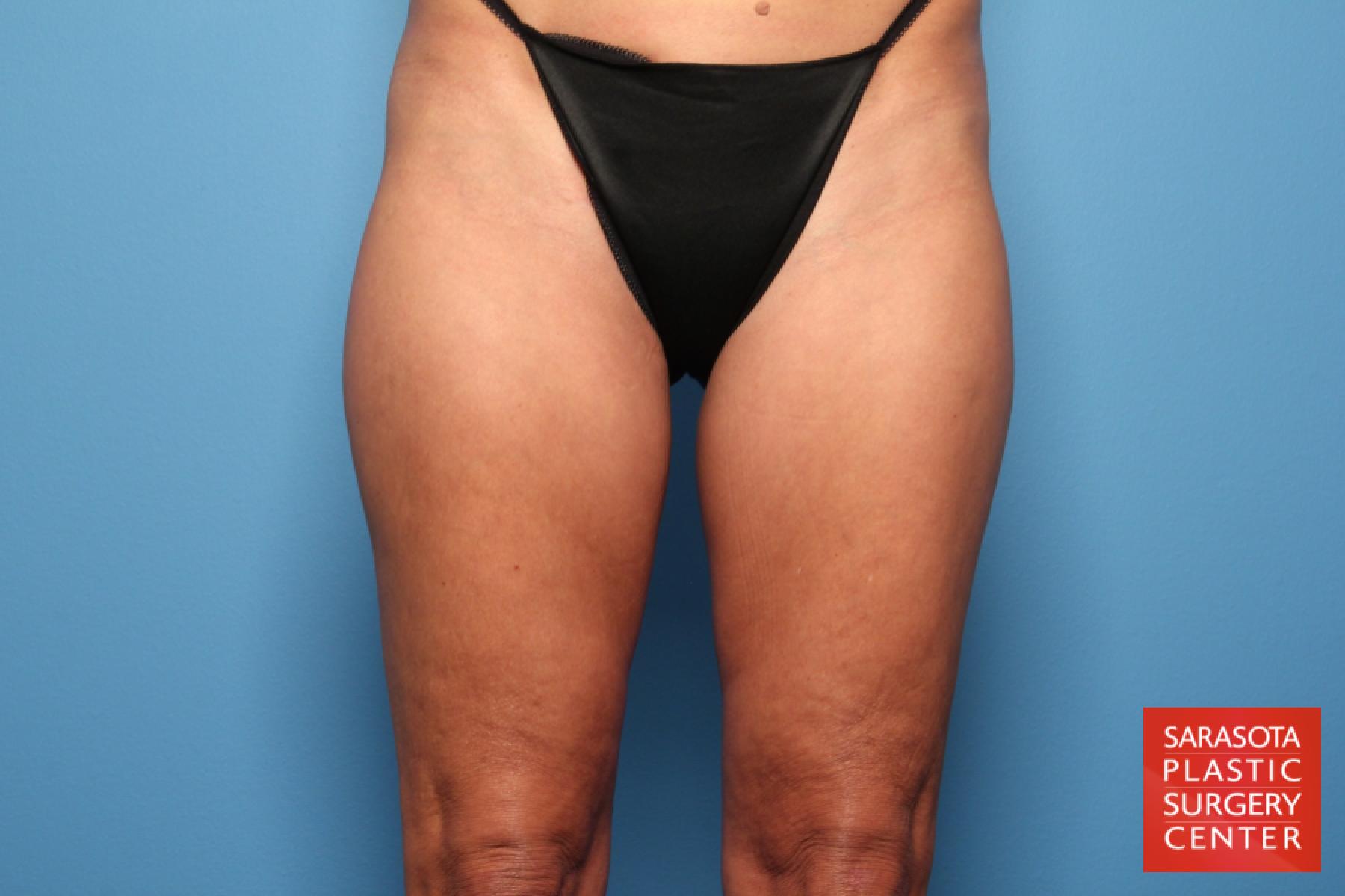 Liposuction: Patient 3 - Before 1