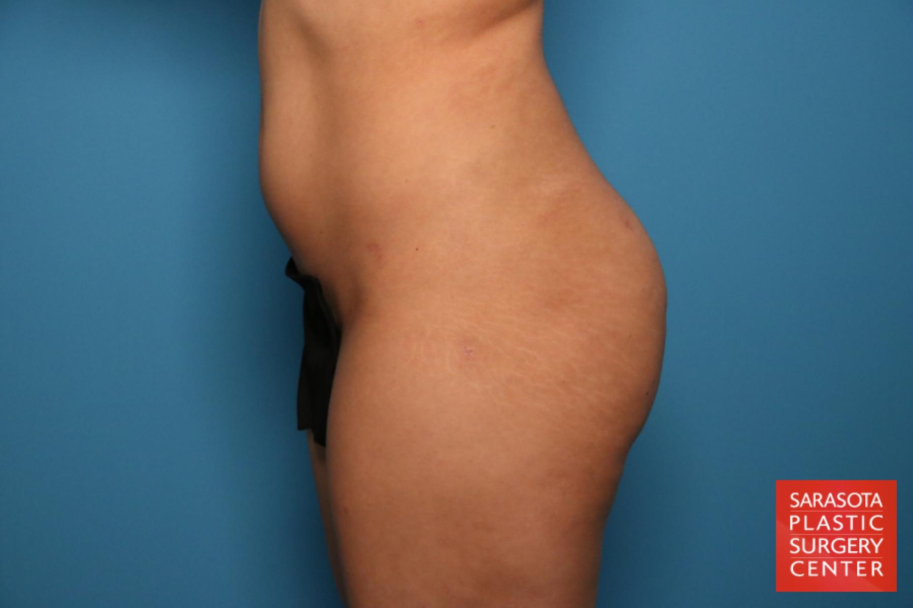 Liposuction: Patient 15 - After 3