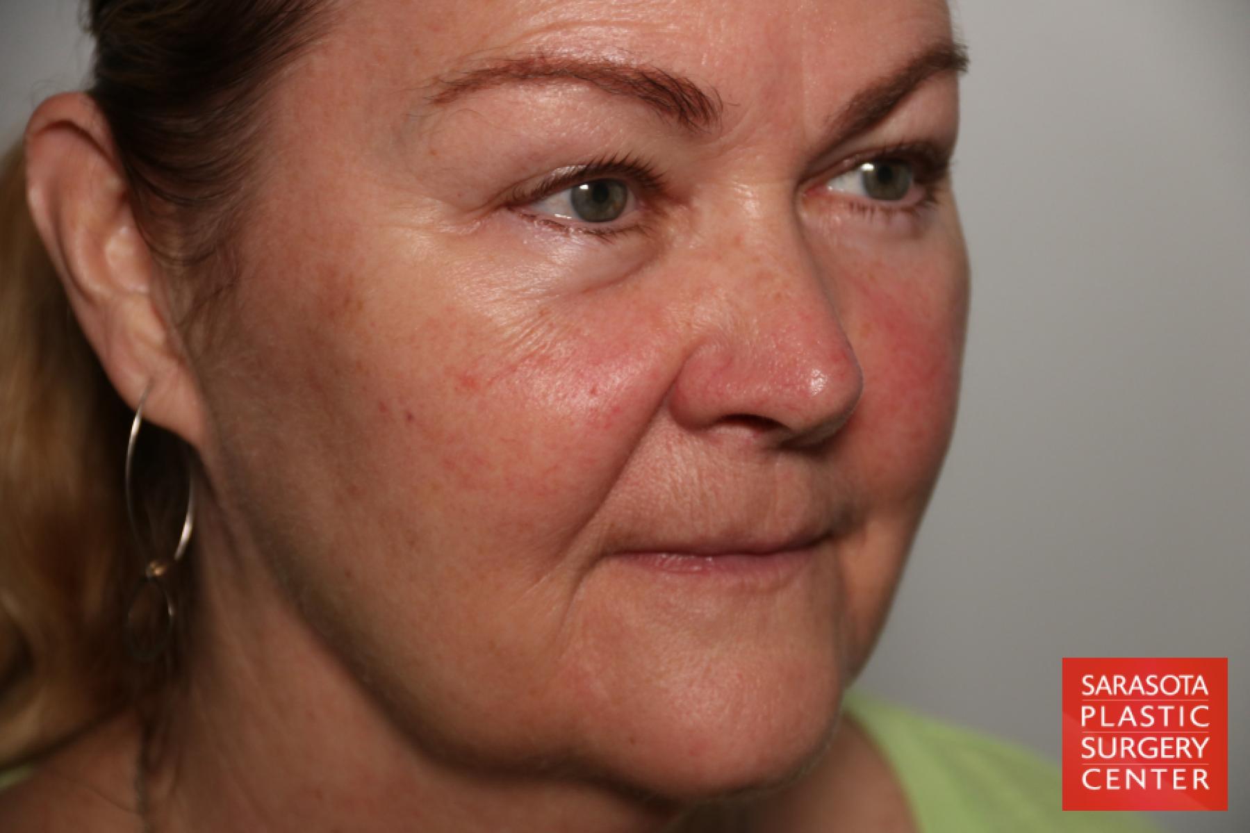 Laser Skin Resurfacing - Face: Patient 17 - Before and After 3