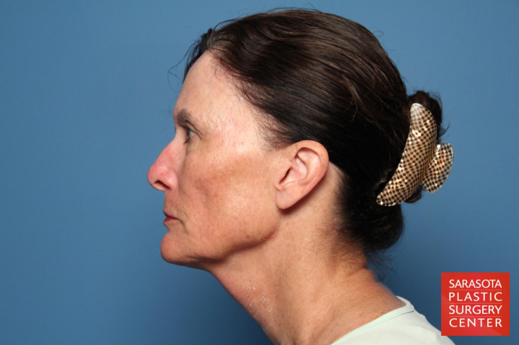 Facelift: Patient 37 - Before and After 3