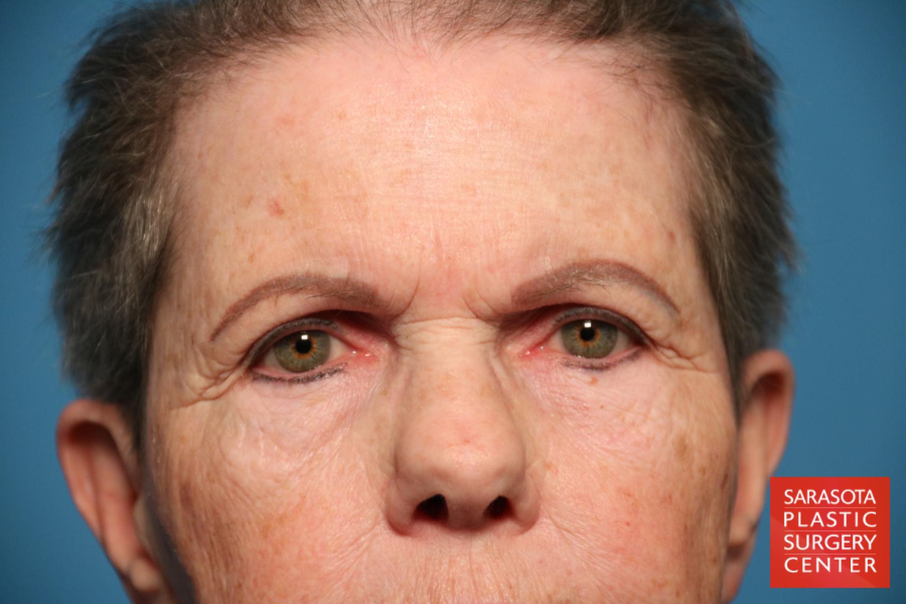 Eyelid Lift: Patient 29 - Before 1