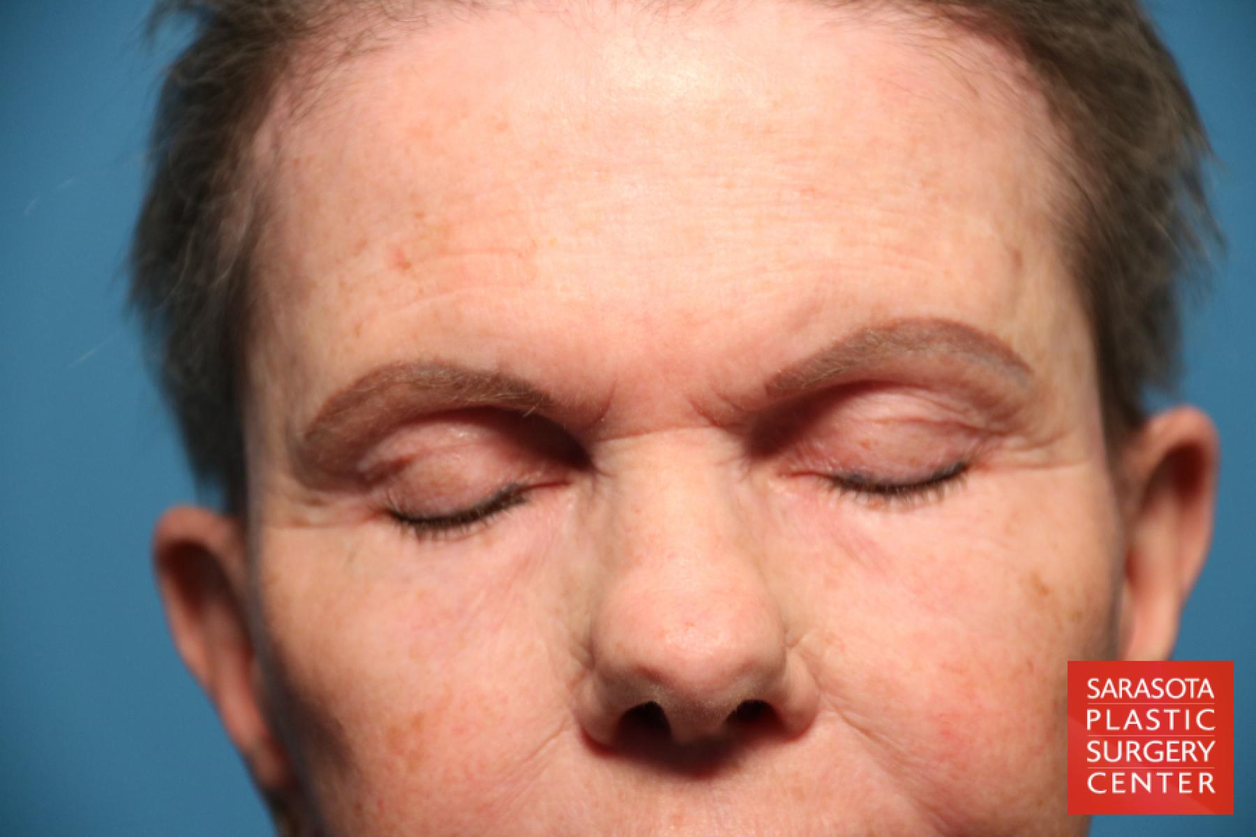 Eyelid Lift: Patient 29 - After 2