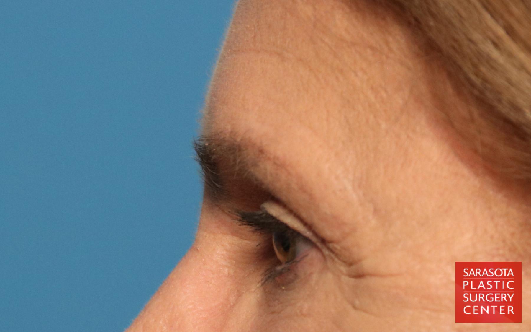 Brow Lift: Patient 1 - After 3