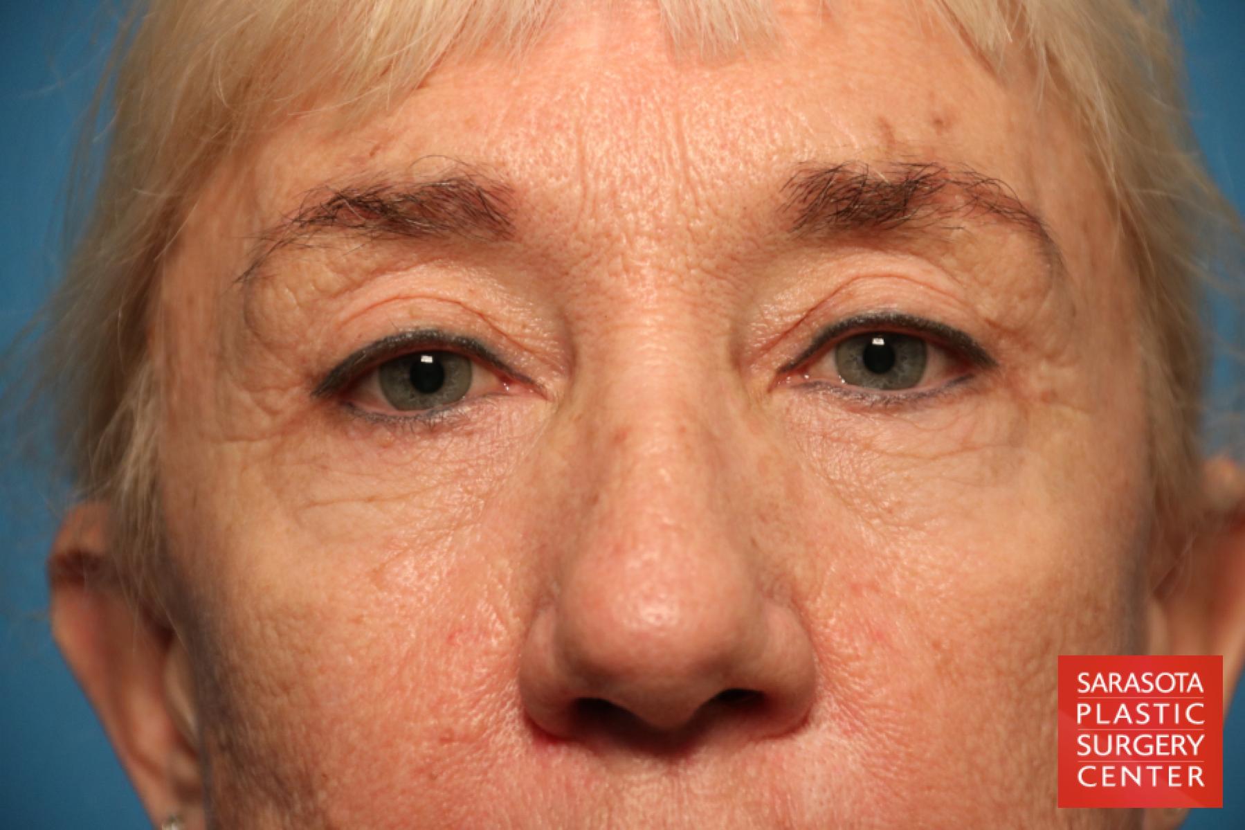 Eyelid Lift: Patient 45 - Before 1