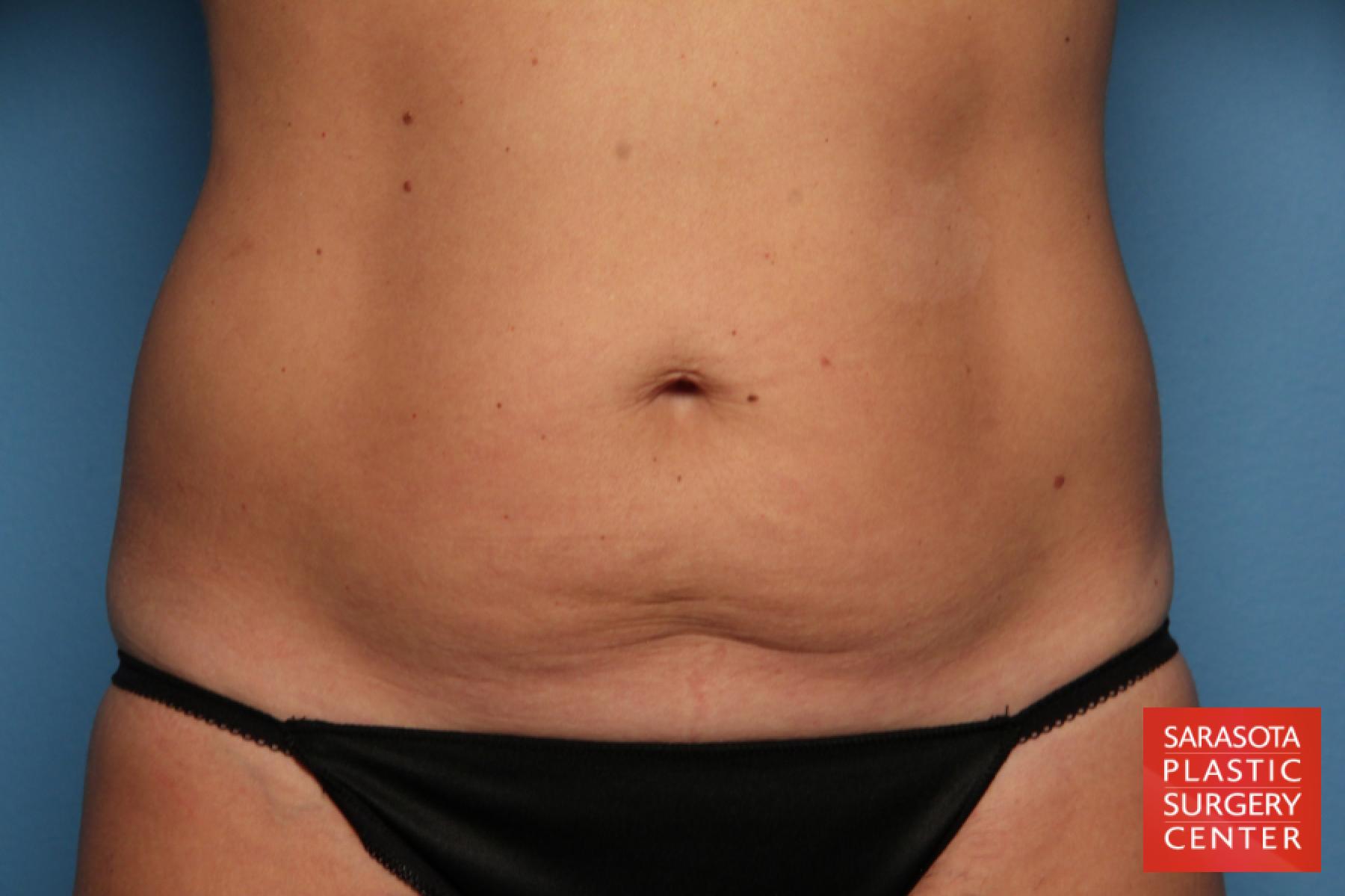 Tummy Tuck: Patient 8 - Before 1