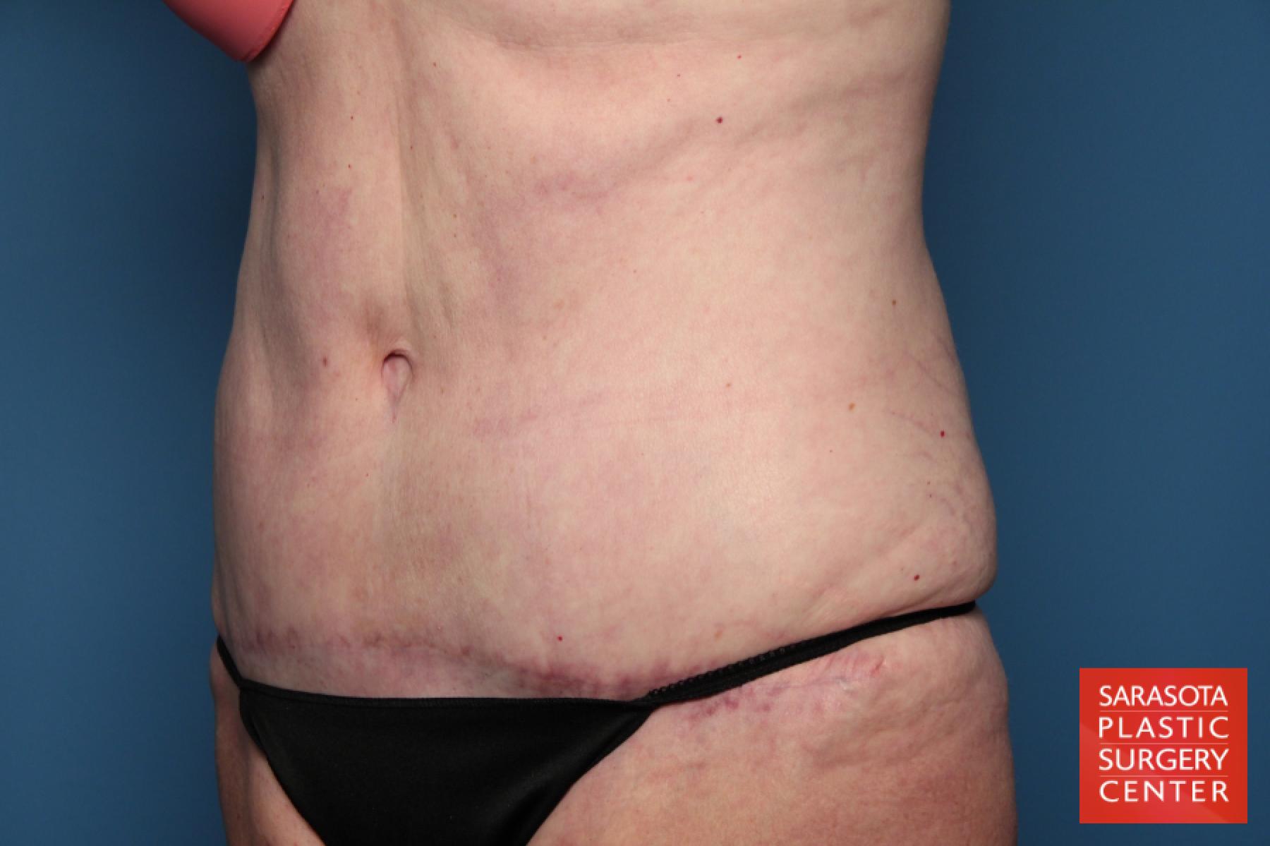 Tummy Tuck: Patient 15 - After 3