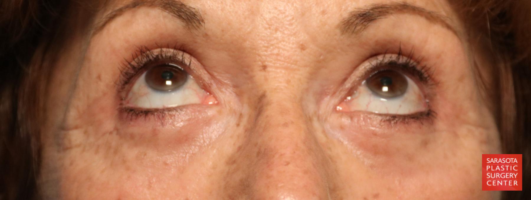 Eyelid Lift: Patient 6 - After 2