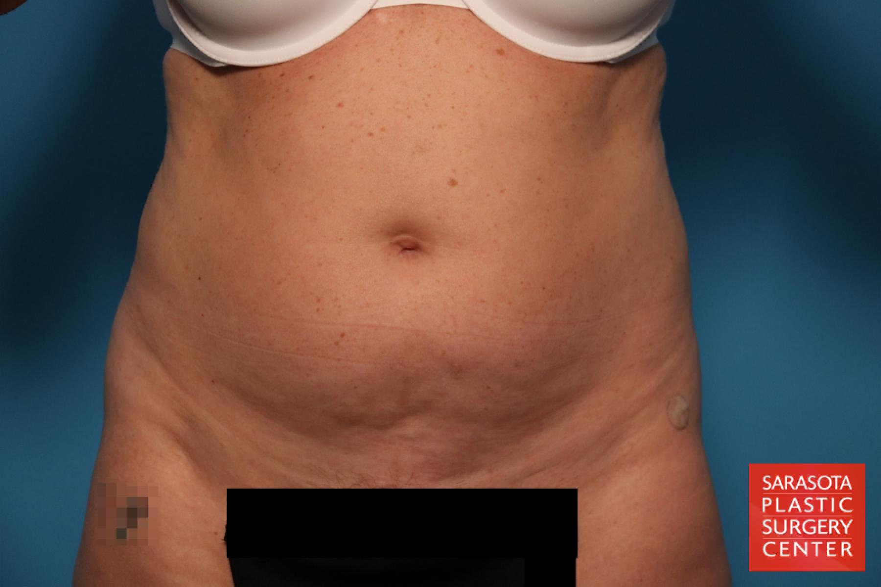 Tummy Tuck: Patient 22 - Before 1