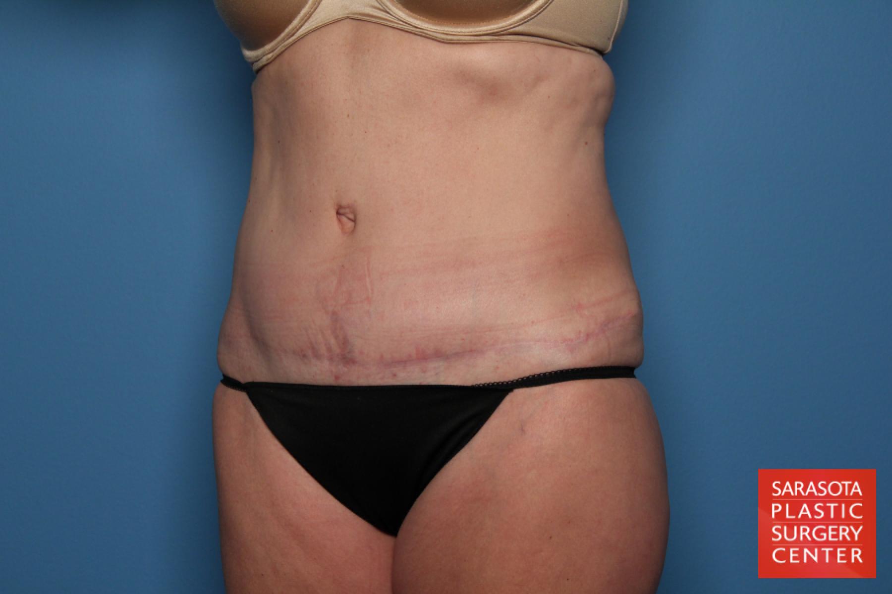 Tummy Tuck: Patient 18 - After 2