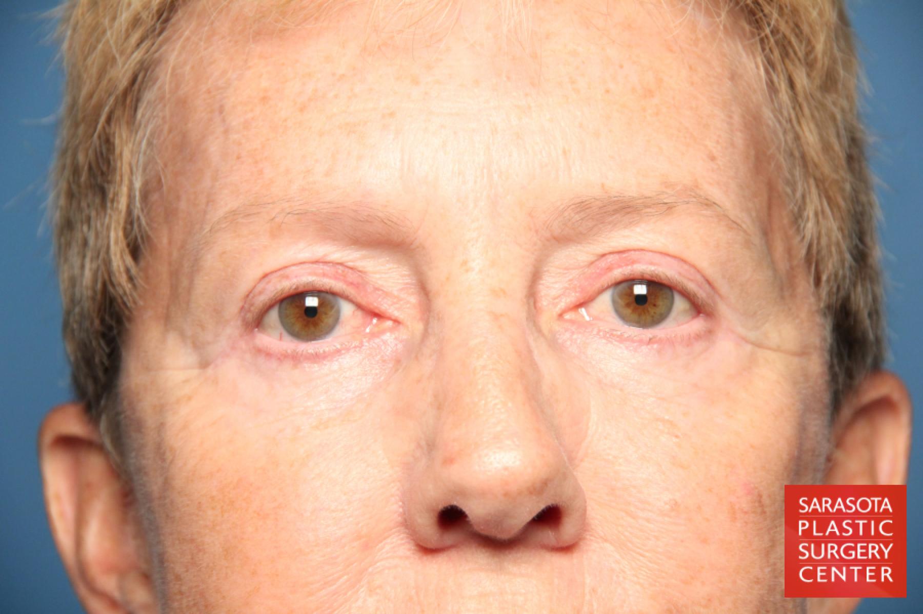 Eyelid Lift: Patient 22 - After 1