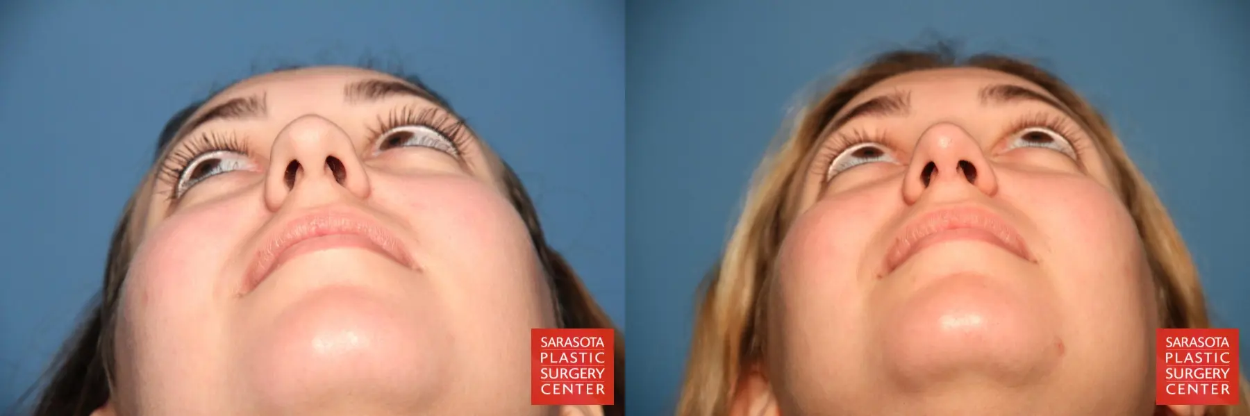 Rhinoplasty: Patient 2 - Before and After 6