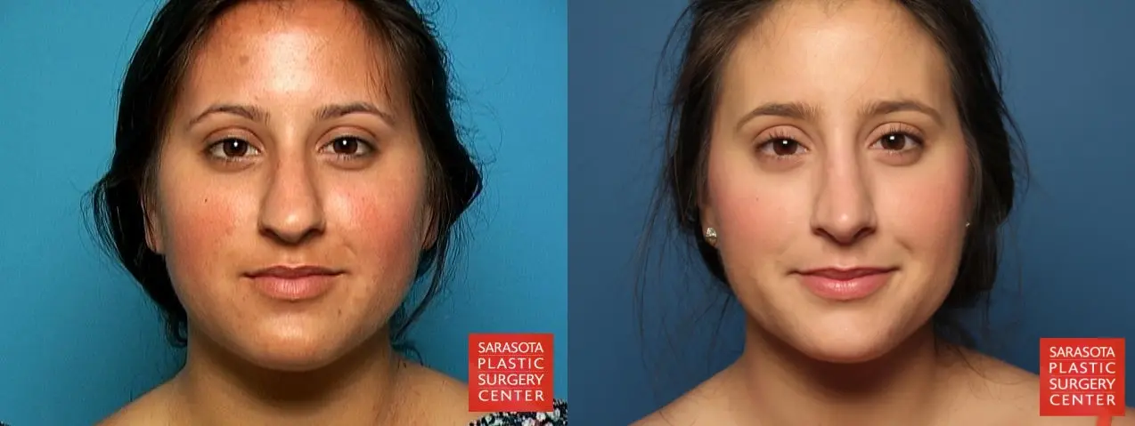 Rhinoplasty: Patient 1 - Before and After  