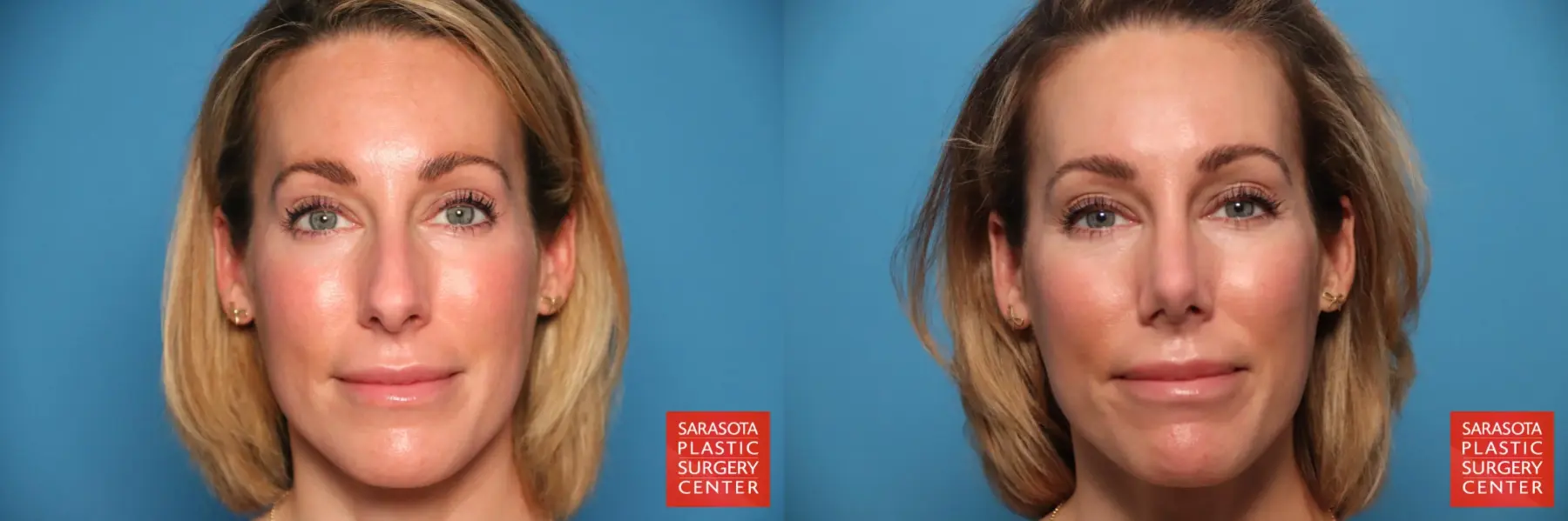 Rhinoplasty: Patient 12 - Before and After  