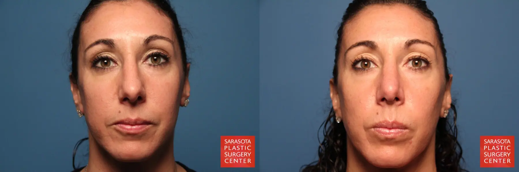 Rhinoplasty: Patient 5 - Before and After  