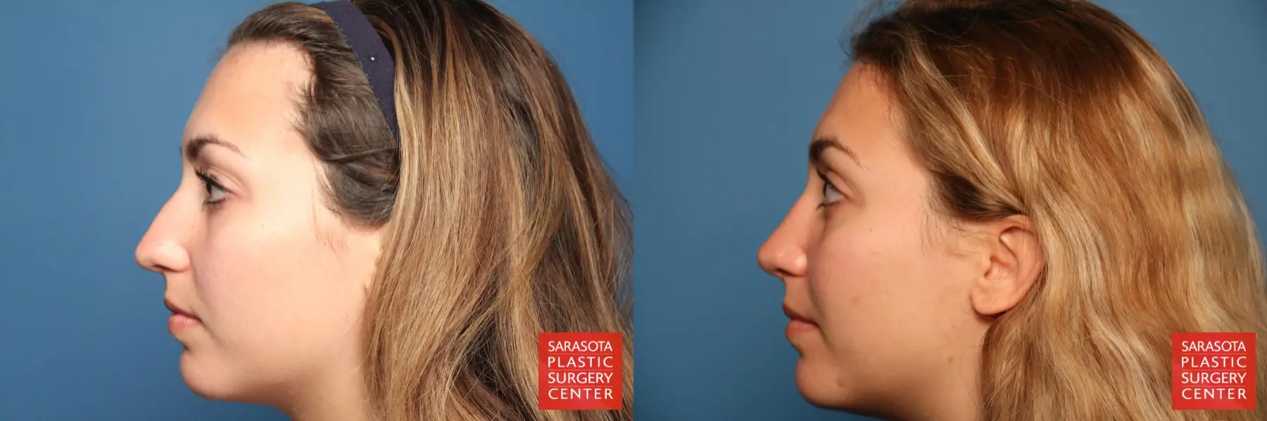 Rhinoplasty: Patient 2 - Before and After 3