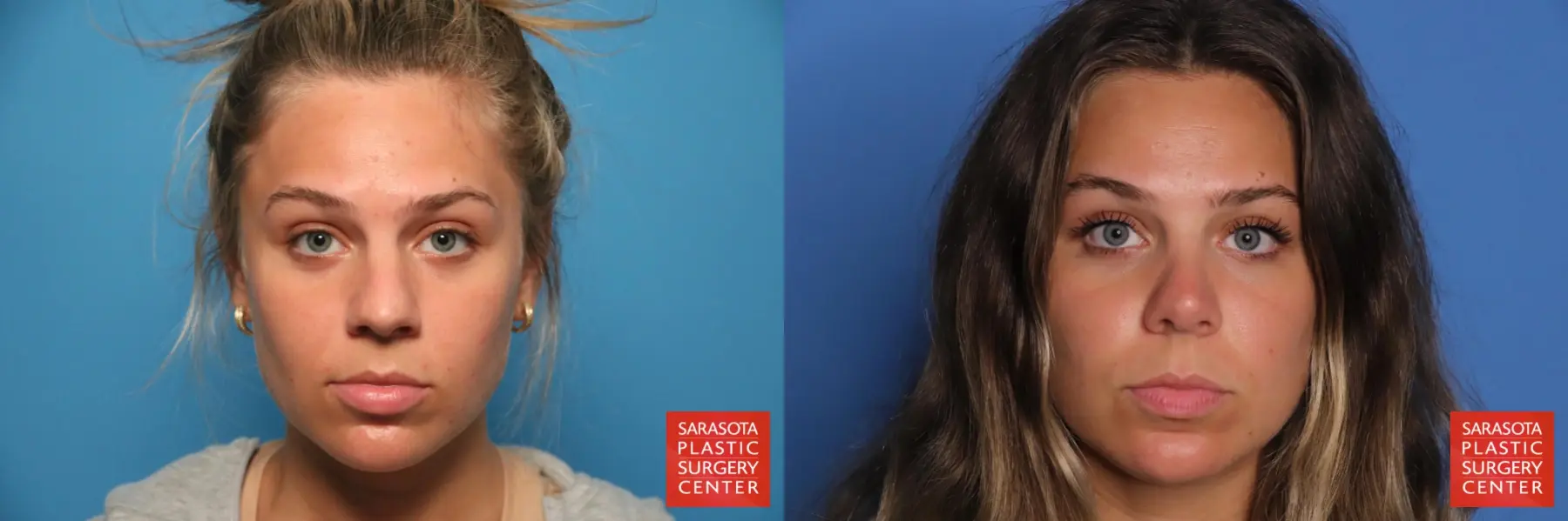 Rhinoplasty: Patient 33 - Before and After  