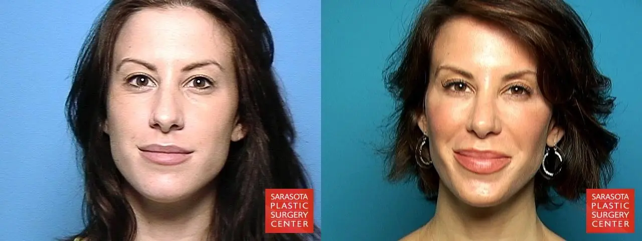 Rhinoplasty: Patient 10 - Before and After 1