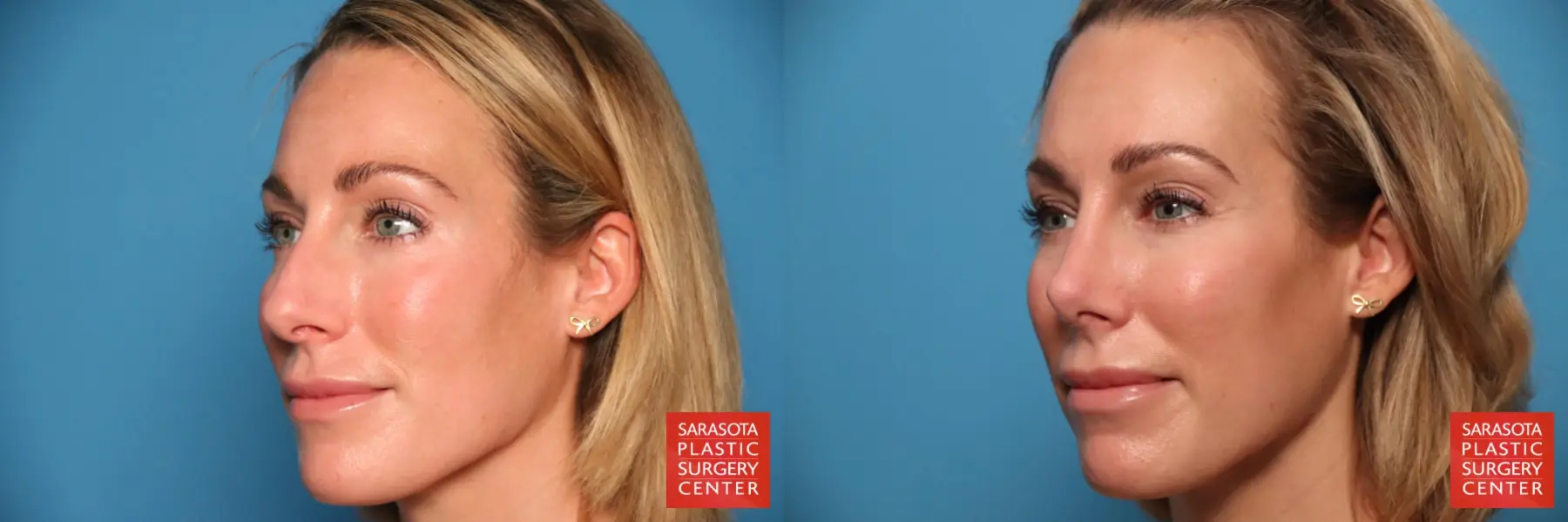 Rhinoplasty: Patient 12 - Before and After 2