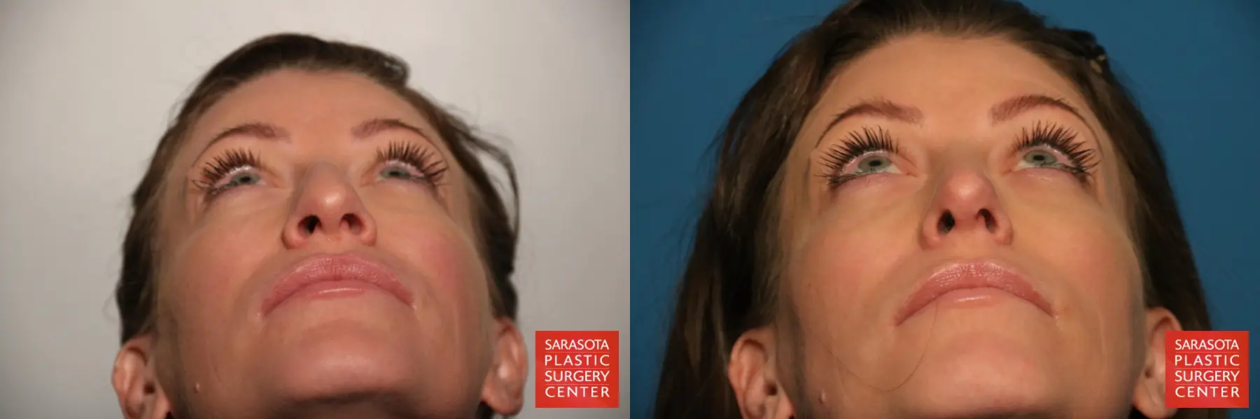 Rhinoplasty: Patient 6 - Before and After 4