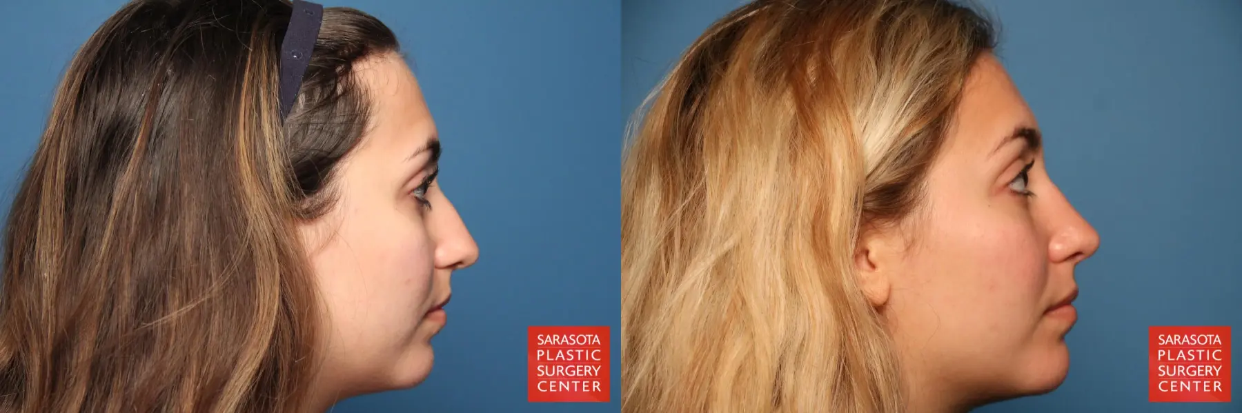 Rhinoplasty: Patient 2 - Before and After 5