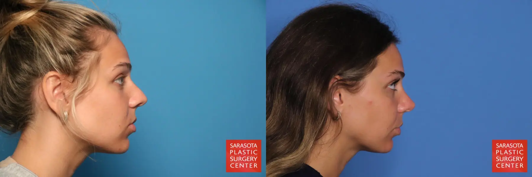 Rhinoplasty: Patient 33 - Before and After 5
