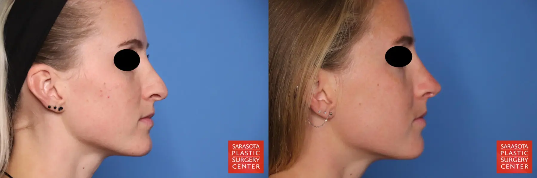 Rhinoplasty: Patient 11 - Before and After 5