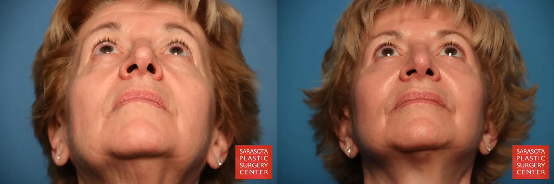 Rhinoplasty: Patient 4 - Before and After 4