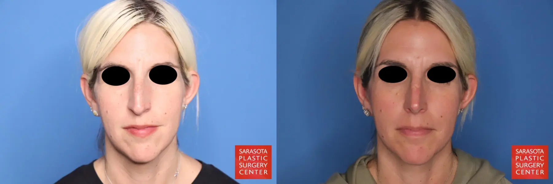 Rhinoplasty: Patient 36 - Before and After  