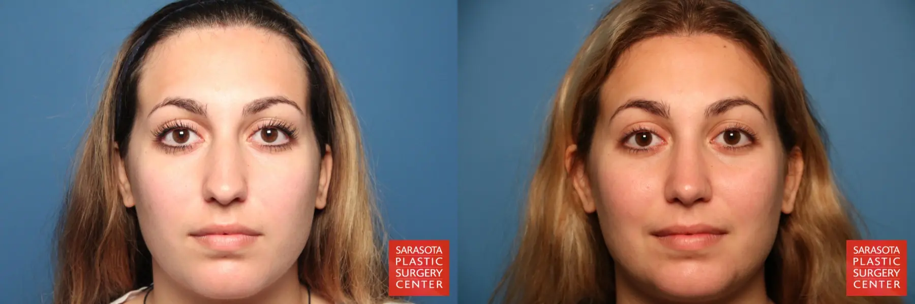 Rhinoplasty: Patient 3 - Before and After  