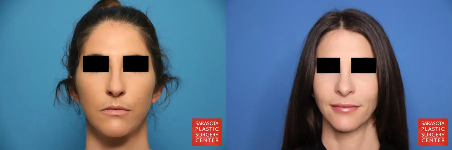 Rhinoplasty: Patient 9 - Before and After  