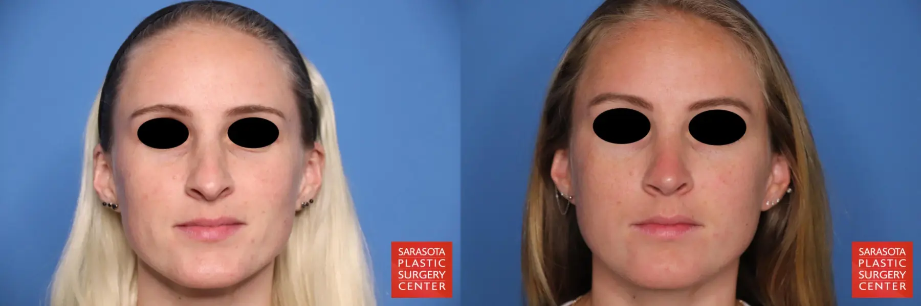 Rhinoplasty: Patient 30 - Before and After  